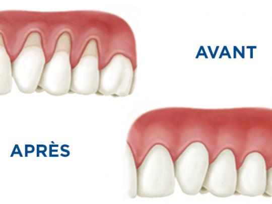 Surfaçage radiculaire dentaire el hissen dental