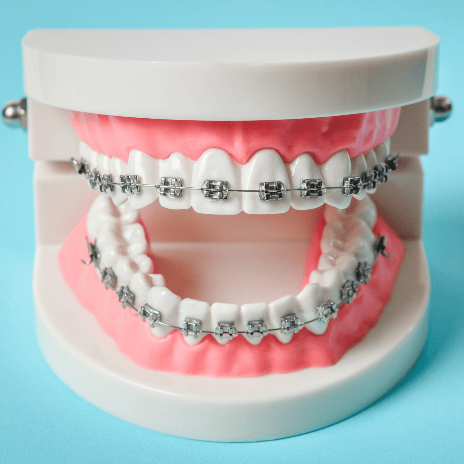 Invisalign ou Bagues