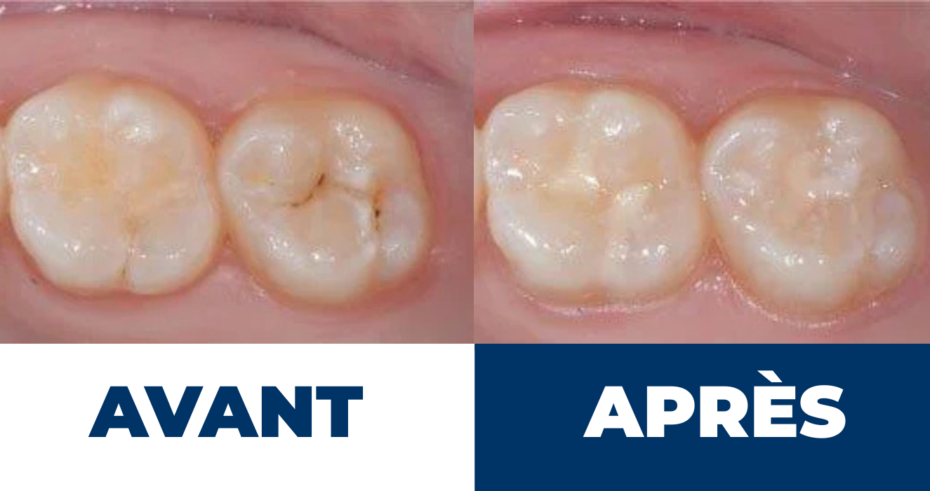 sealant dentaire el hissen dental