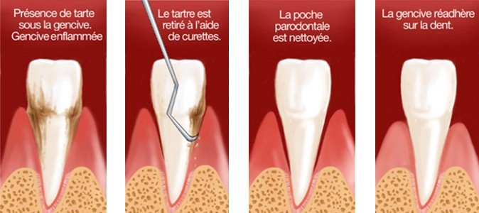 Surfaçage radiculaire dentaire el hissen dental